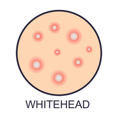 Skin white head problems vector illustration. Sign of dry or oily skin problems isolated on white background. Health, skincare concept