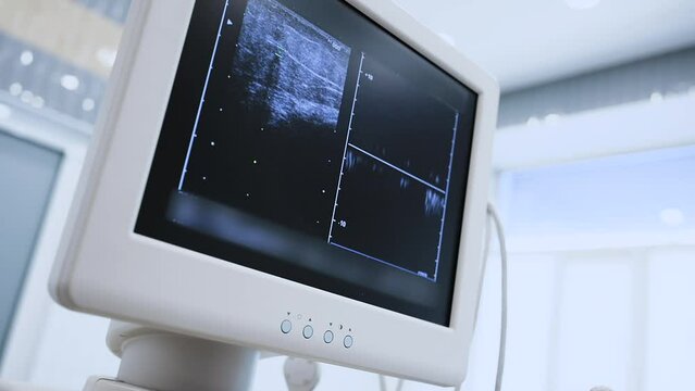 close-up on the ultrasound monitor of the veins of the patient's lower extremities. varicose veins