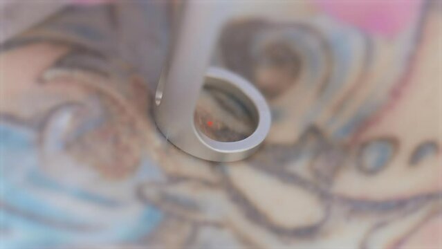 cosmetologist removes a tattoo to a patient using a neodymium laser in a modern clinic