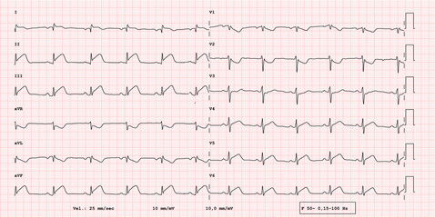 ECG example of 12-lead rhythm, acute myocardial infarction, real exam