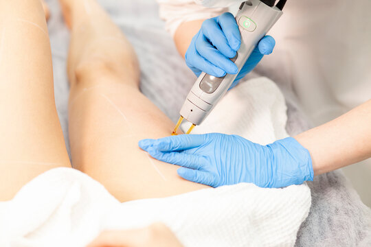epilation of legs in cosmetology clinic. doctor cosmetologist doing hair removal procedure with alexandrite laser