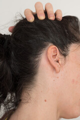 scalp of a woman with psoriasis, dandruff in the hair