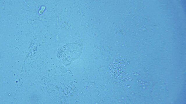 Microscopy of human lungs. Contents of pus from the lungs. Acute bronchitis, pneumonia, tuberculosis, pneumonia, coronavirus
