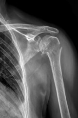X-ray image of a broken shoulder bone, fracture neck of Humerus bone.