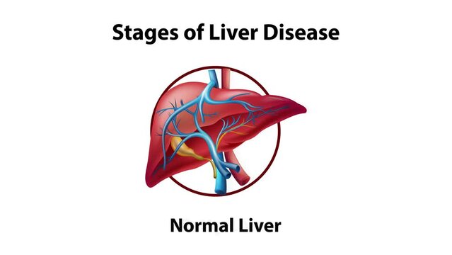 2D animation of stages of liver disease.