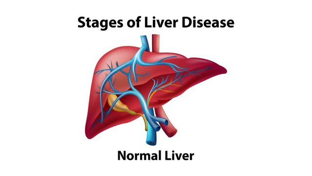 2D animation of stages of liver disease.