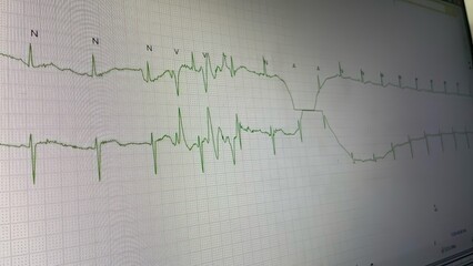 Electrocardiograph (EKG) artifacts are defined as EKG abnormalities