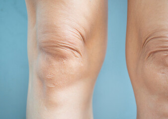 lesion, dermatitis dark spots of the skin on the legs