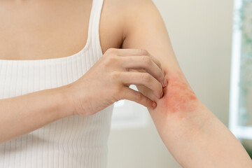 Dermatology asian young woman, girl allergy, allergic reaction from atopic, insect bites on her arm, hand in scratching itchy, itch red spot or rash of skin. Healthcare, treatment of beauty.