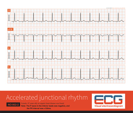 QRS Interval On Your Watch ECG Narrow, Normal, And Wide, 57% OFF