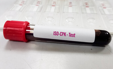 Blood sample for ISO-CPK (isoenzyme of creatinine phosphokinase) enzyme test. Diagnosis of muscle or tissue injuries. Myocardial infection. - obrazy, fototapety, plakaty