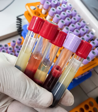 Lipemic blood sample, frees serum, whole blood, hemolyzed serum, Lipemia in a blood specimen can false result.