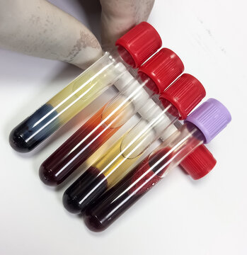 Lipemic blood sample, frees serum, whole blood, hemolyzed serum, Lipemia in a blood specimen can false result.
