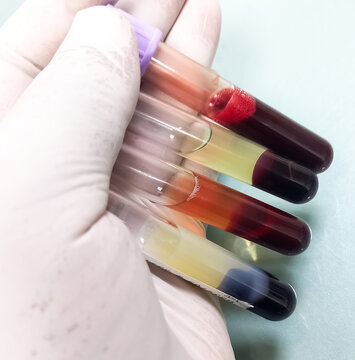 Lipemic blood sample, frees serum, whole blood, hemolyzed serum, Lipemia in a blood specimen can false result.