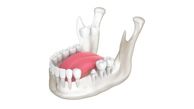  Mandible with dental cantilever bridge over white background