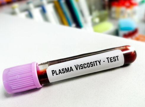Blood sample for Plasma Viscosity test, Diagnosis for Polymyalgia rheumatica, giant cell arteritis or temporal arteritis, such as headaches, neck or shoulder pain, pelvic pain, joint stiffness.