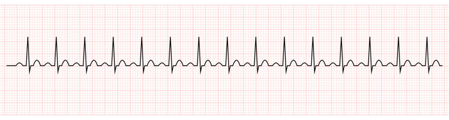 EKG Showing Sinus tachycardia of Patient 