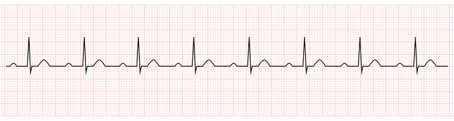 EKG Showing PR prolong which is Sign of First degree AV Block