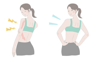 免疫機能が落ちると発症しやすい帯状疱疹の発疹が出た女性と治癒後