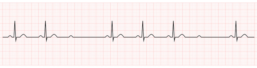 EKG Showing second degree av block mobitz II