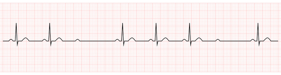 EKG Showing second degree av block mobitz II