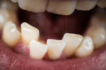 European male open mouth crooked teeth