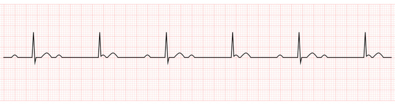 EKG Showing third degree or complete av block