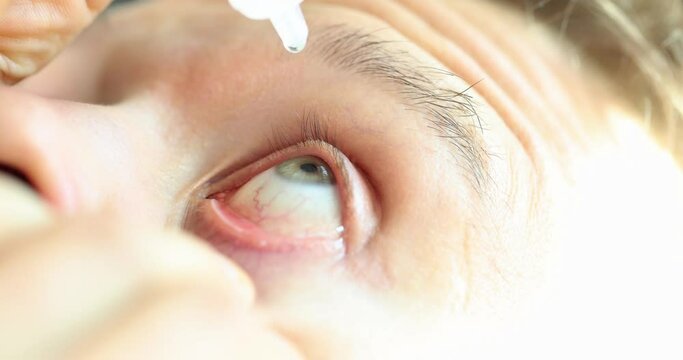 Man instilling eye drops from allergies closeup 4k movie slow motion 