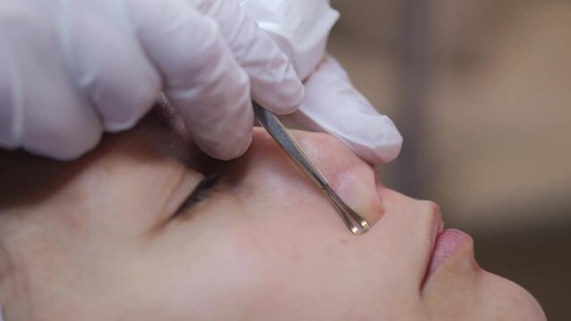 Super closeup of a Caucasian woman's nose receiving blackhead removal treatment