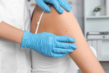 Dermatologist examining patient's birthmark in clinic, closeup