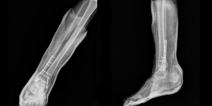 Radiography of osteosynthesis of the ankle joint