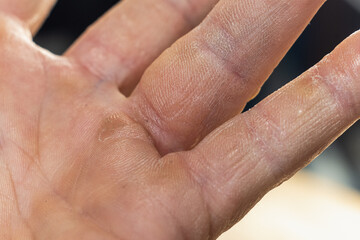 rash on fingers dyshidrotic eczema