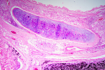 Chronic bronchitis disease human cells