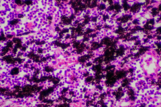 Chronic bronchitis disease human cells