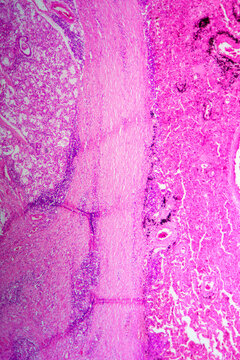 Chronic bronchitis disease human cells