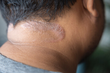 Naklejka premium Dark-skinned Asian men suffer from scalp dermatitis due to moisture-causing fungi. fungal itching. skin diseases-allergies, psoriasis, eczema, dermatitis.