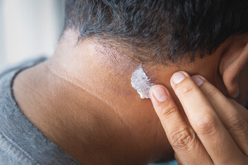 Dark-skinned Asian men apply skin treatment suffer from scalp dermatitis due to moisture-causing fungi. fungal itching. skin diseases-allergies, psoriasis, eczema, dermatitis. - obrazy, fototapety, plakaty