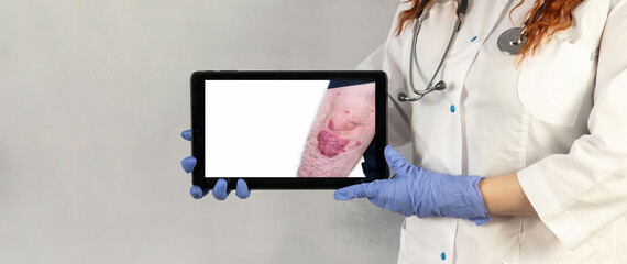 Psoriasis.Doctor holding a tablet, photo of a man with psoriasis.Autoimmune genetic disease.Man...