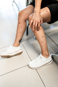 woman with mosquito bites