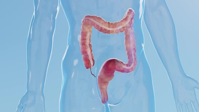 3D rendered medical animation of a man's inflamed colon