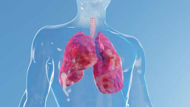 3D rendered medical animation of a man's inflamed lungs
