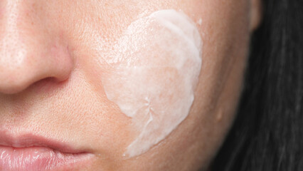 Facial skin with enlarged pores. Cream on the skin. Care for problem skin.