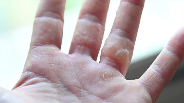 rash on fingers dyshidrotic eczema