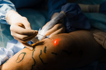 Endovenous laser coagulation for treatment varicose veins. Vascular surgeon is operating using EVLT...