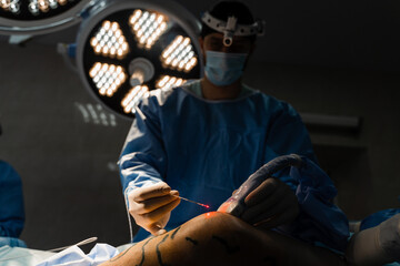 Endovenous laser coagulation for treatment varicose veins. Vascular surgeon is operating using EVLT...