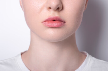 woman asymmetric lips as a result after lip augmentation with hyaluronic acid filler entered...