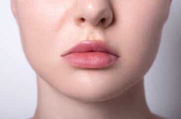 woman asymmetric lips as a result after lip augmentation with hyaluronic acid filler entered incorrectly, cosmetologist's mistake, contour lip plastic surgery