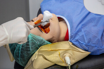 Laser vision correction.Patient and team of surgeons in the operating room during ophthalmic...