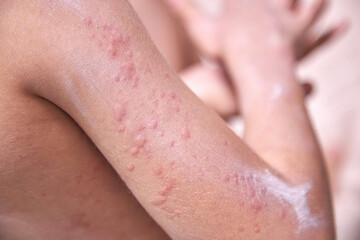 food allergy. a boy with red spots. The child has itching, with an allergic rash..