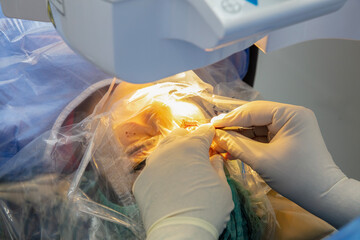 Laser vision correction.Patient and team of surgeons in the operating room during ophthalmic...